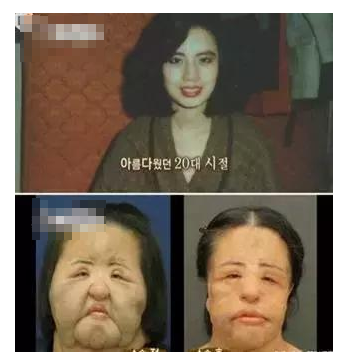 整容發(fā)生意外保險賠嗎？